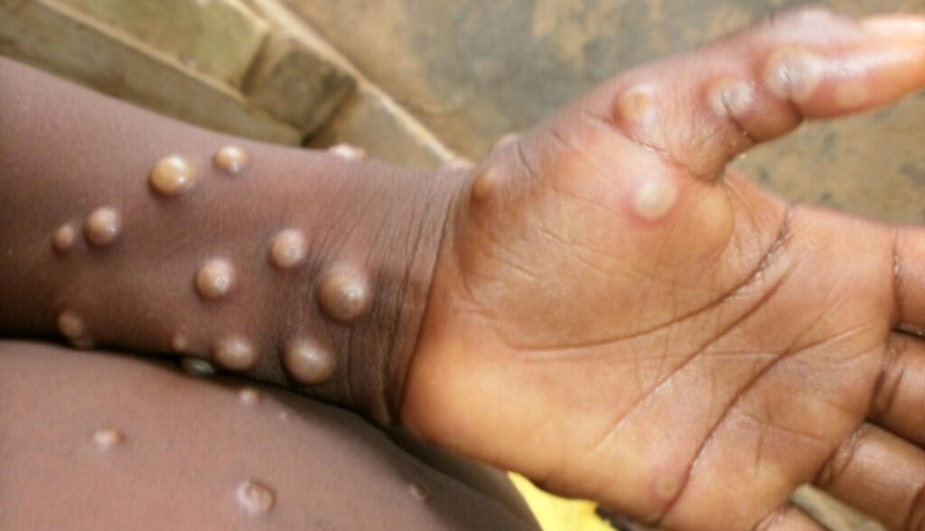 95% by'abandura Mpox bayikura mu mibonano mpuzabitsina 31 mpox