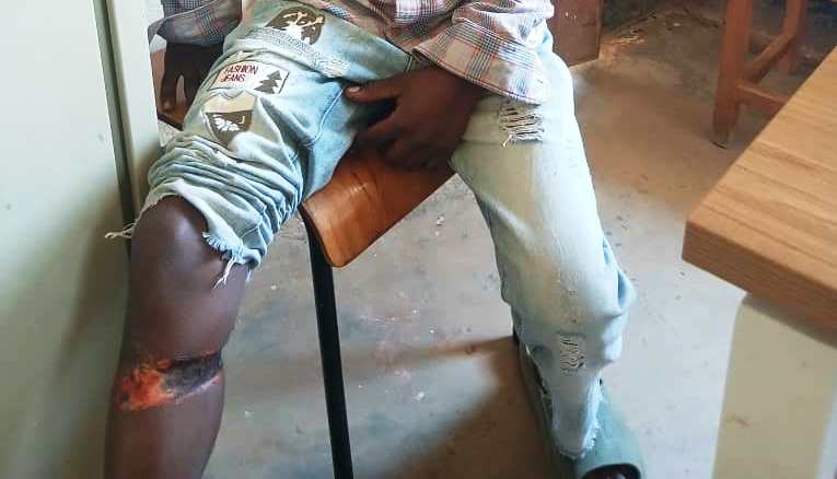 Girishyaka Niyitanga Fabrice bamutwitse bikomeye munsi yivi