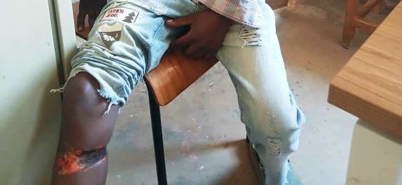 Girishyaka-Niyitanga-Fabrice-bamutwitse-bikomeye-munsi-yivi