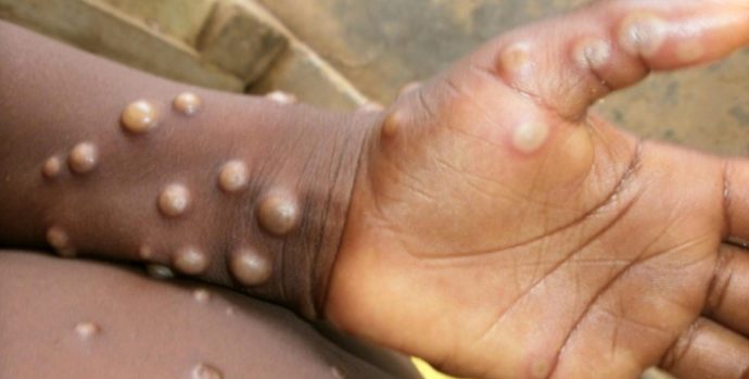 mpox
