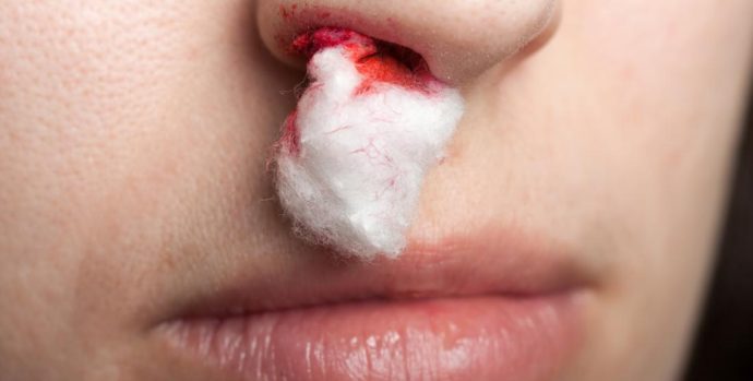 nose-bleed-stopped-with-cotton-wool