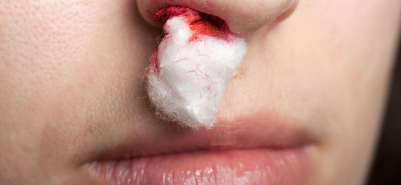 nose-bleed-stopped-with-cotton-wool